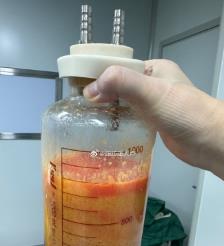 长宁水动力吸脂手术要做多久？